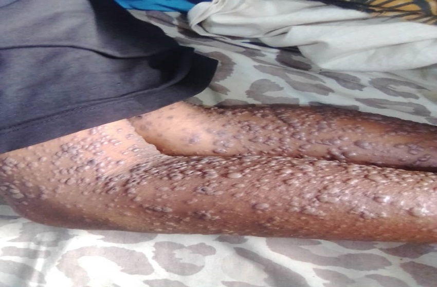 Pas de cas de variole du singe au Burundi